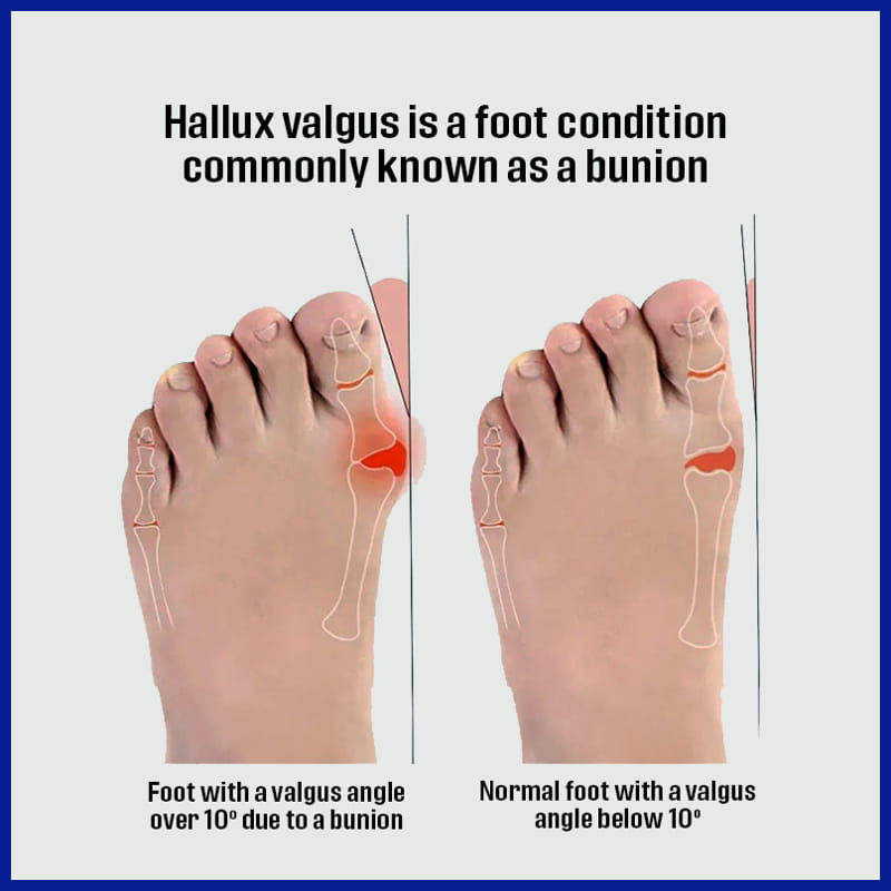 Hallux Valgus Diagram